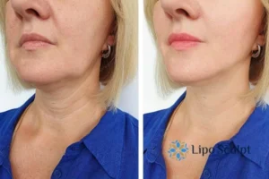 Double chin before and after Hi-Fu treatment 4 Book your double chin treatment Small Heath today! We are here to help!