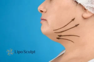 Double chin before and after Hi-Fu treatment 3 Boost your confidence with a Double chin treatment Small Heath