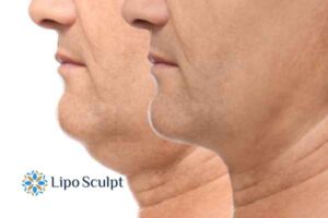Double chin before and after Hi-Fu treatment 2 Double chin treatment Small Heath from Lipo Sculpt - feel more confident today!