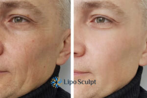 How to Fight Aging Symptoms 3 Fight Aging Symptoms Small Heath With HIFU and Morpheus8 Today!