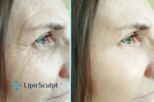 How to Fight Aging Symptoms 2 Do you want to Fight Aging Symptoms Small Heath? Contact Lipo Sculpt today!