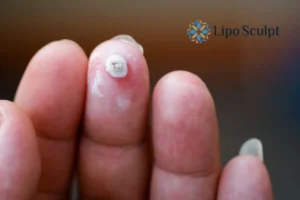 Cryopen Top 5 Treatable Conditions 4 Do you have a persistent wart of verruca that you cannot shit? Cryopen Small Heath treatment will work call us NOW!