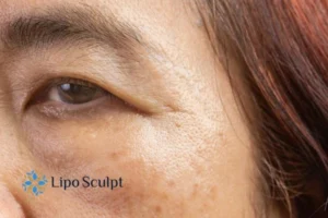 Cryopen: The Revolutionary Treatment for Age Spots Unveiled 2 Are age spots Small Heath giving you low self esteem? Contact us today!