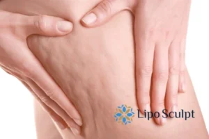 CoolSculpting for Legs: The Innovative Approach to Redefining Your Legs 5 Start your journey today book your coolsculpting treatment Small Heath online today!