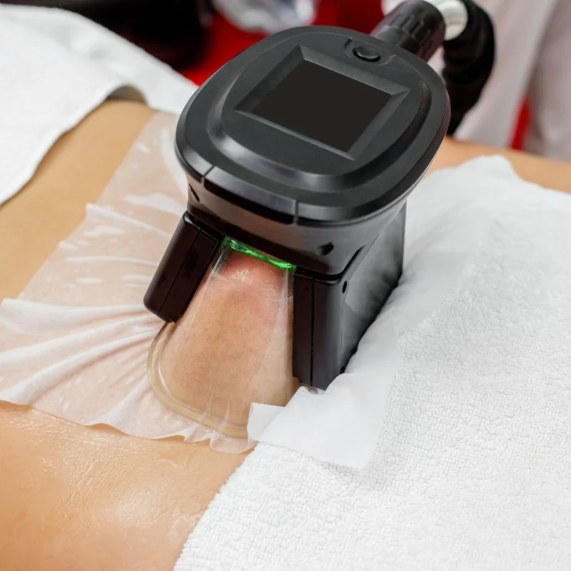 Fat Freezing treatment Small Heath